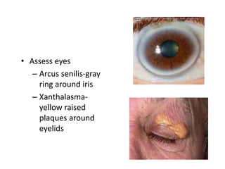 • Assess eyes
– Arcus senilis-gray
ring around iris
– Xanthalasmayellow raised
plaques around
eyelids

 