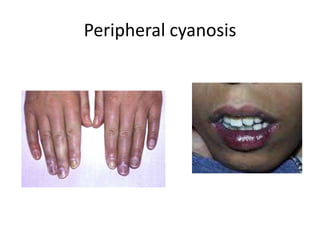 Peripheral cyanosis

 