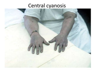 Central cyanosis

 