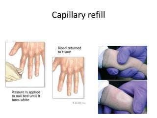 Capillary refill

 