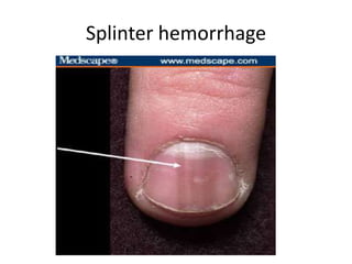 Splinter hemorrhage

 