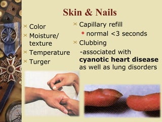 Skin & Nails
 Color
 Moisture/
texture
 Temperature
 Turger
 Capillary refill
normal <3 seconds
 Clubbing
-associated with
cyanotic heart disease
as well as lung disorders
 