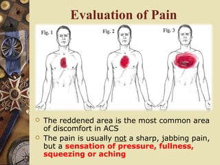 Evaluation of Pain
 The reddened area is the most common area
of discomfort in ACS
 The pain is usually not a sharp, jabbing pain,
but a sensation of pressure, fullness,
squeezing or aching
 