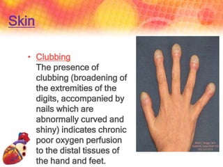 Clubbing Pathophysiology Notes Cardiac assessment ppt | PPTX