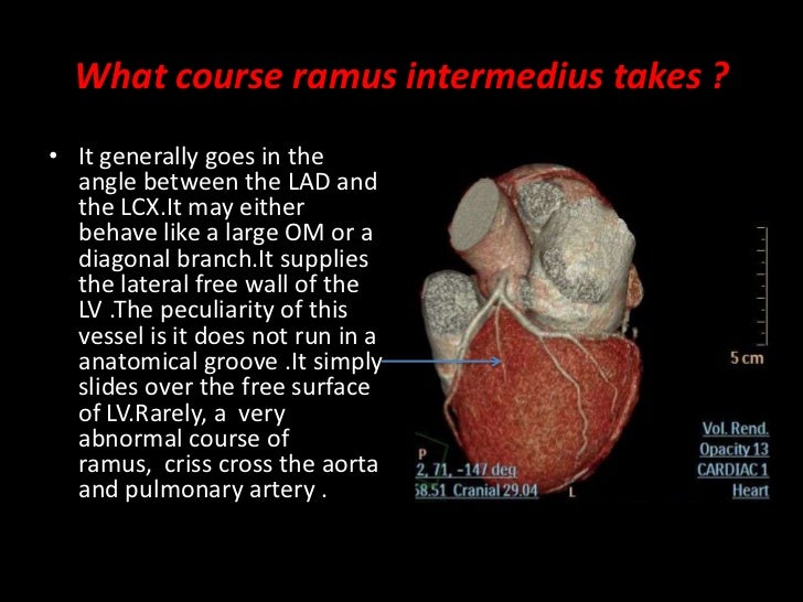 Cardiac case series ramus intermedius