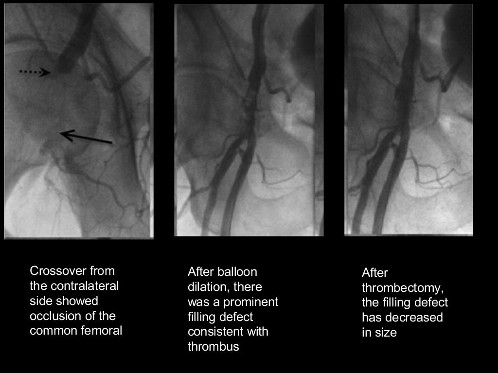 Cardiac cath complications