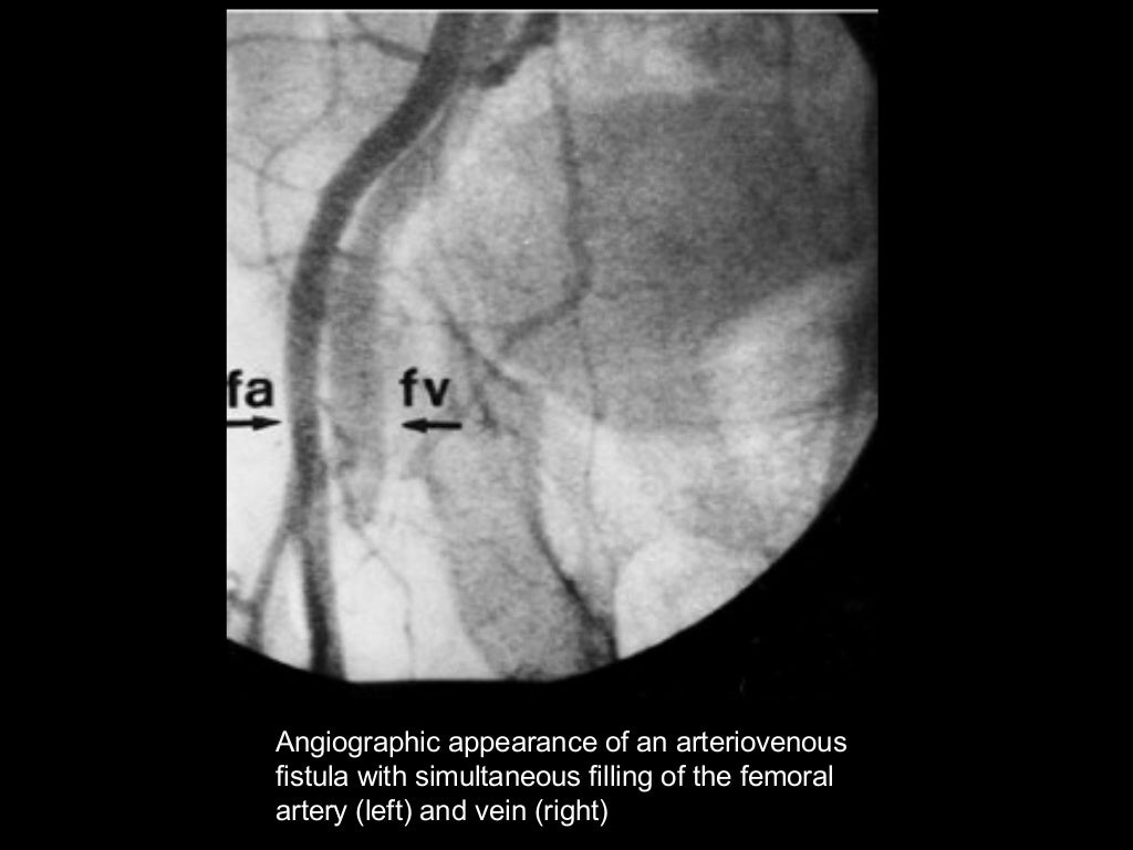 Cardiac cath complications