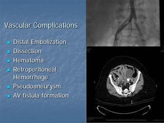 Vascular Complications
 Distal Embolization
 Dissection
 Hematoma
 Retroperitoneal
Hemorrhage
 Pseudoaneurysm
 AV fistula formation
 