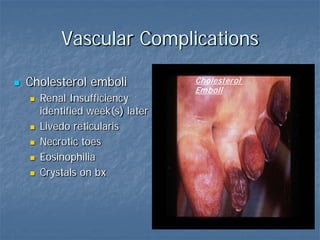 Vascular Complications
 Cholesterol emboli
 Renal Insufficiency
identified week(s) later
 Livedo reticularis
 Necrotic toes
 Eosinophilia
 Crystals on bx
Cholesterol
Emboli
 
