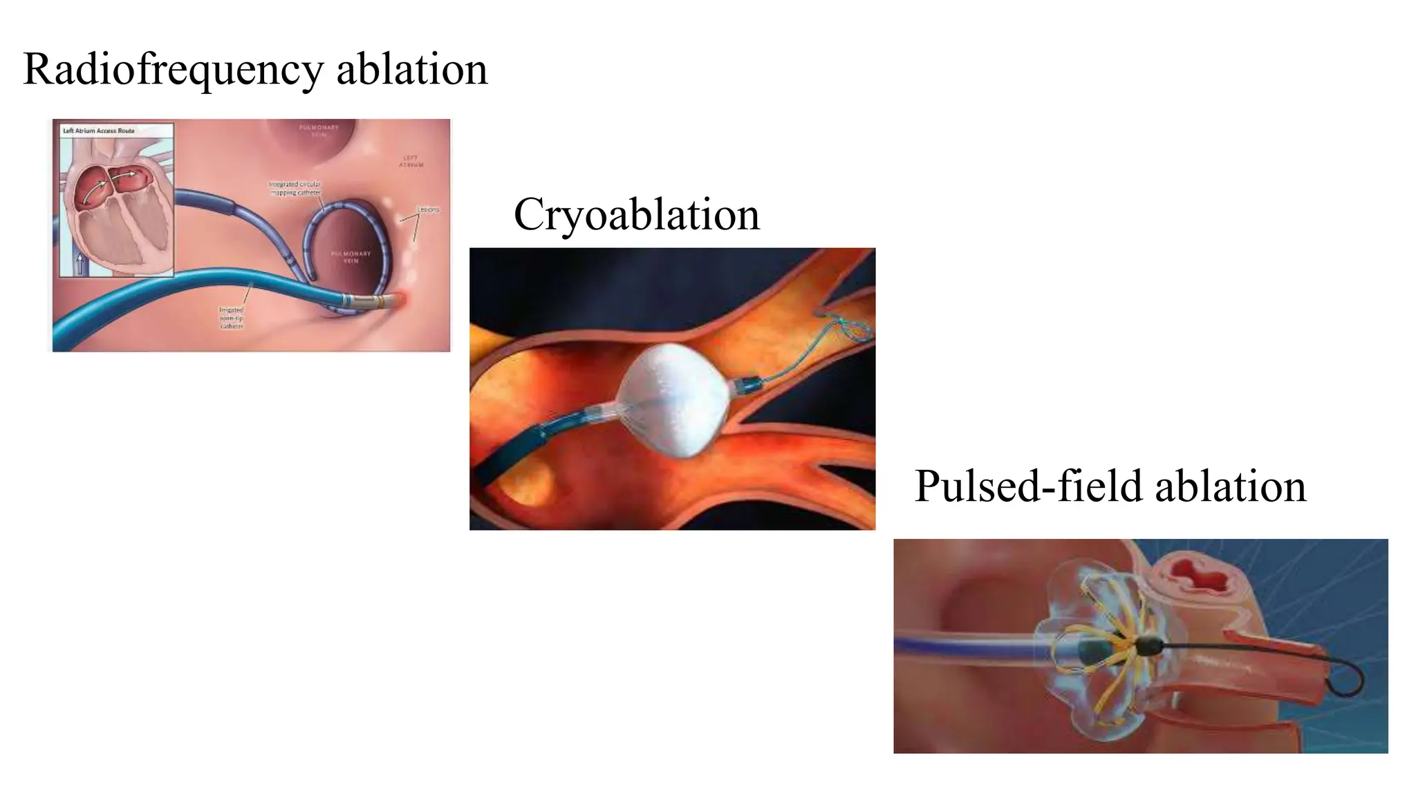 Cardiac Cryoablation.pptx