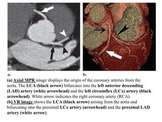 (a) Axial MPR image displays the origin of the coronary arteries from the
aorta. The LCA (black arrow) bifurcates into the left anterior descending
(LAD) artery (white arrowhead) and the left circumflex (LCx) artery (black
arrowhead). White arrow indicates the right coronary artery (RCA).
(b) VR image shows the LCA (black arrow) arising from the aorta and
bifurcating into the proximal LCx artery (arrowhead) and the proximal LAD
artery (white arrow).
 