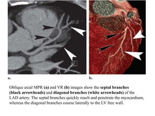 Oblique axial MPR (a) and VR (b) images show the septal branches
(black arrowheads) and diagonal branches (white arrowheads) of the
LAD artery. The septal branches quickly reach and penetrate the myocardium,
whereas the diagonal branches course laterally to the LV free wall.
 