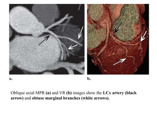 Oblique axial MPR (a) and VR (b) images show the LCx artery (black
arrow) and obtuse marginal branches (white arrows).
 