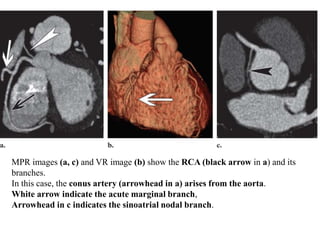 MPR images (a, c) and VR image (b) show the RCA (black arrow in a) and its
branches.
In this case, the conus artery (arrowhead in a) arises from the aorta.
White arrow indicate the acute marginal branch,
Arrowhead in c indicates the sinoatrial nodal branch.
 