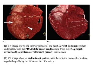 (a) VR image shows the inferior surface of the heart. A right-dominant system
is depicted, with the PDA (white arrowhead) arising from the RCA (black
arrowhead). A posterolateral branch (arrow) is also seen.
(b) VR image shows a codominant system, with the inferior myocardial surface
supplied equally by the RCA and the LCx artery.
 