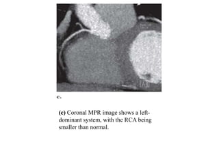(c) Coronal MPR image shows a left-
dominant system, with the RCA being
smaller than normal.
 