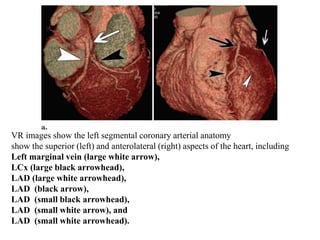 VR images show the left segmental coronary arterial anatomy
show the superior (left) and anterolateral (right) aspects of the heart, including
Left marginal vein (large white arrow),
LCx (large black arrowhead),
LAD (large white arrowhead),
LAD (black arrow),
LAD (small black arrowhead),
LAD (small white arrow), and
LAD (small white arrowhead).
 