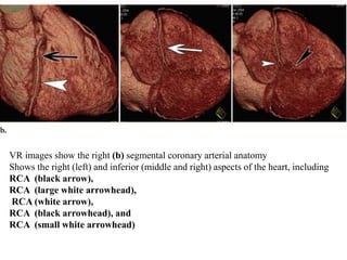 VR images show the right (b) segmental coronary arterial anatomy
Shows the right (left) and inferior (middle and right) aspects of the heart, including
RCA (black arrow),
RCA (large white arrowhead),
RCA (white arrow),
RCA (black arrowhead), and
RCA (small white arrowhead)
 