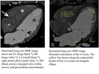 Horizontal long-axis MPR image
shows the LV (large black *), RV
(large white *), LA (small black *),
right atrium (RA) (small white *), MV
(black arrow), tricuspid valve (white
arrow), and pericardium (arrowheads).
Horizontal long-axis MPR image
illustrates calculation of the LA area. The
yellow line drawn along the endocardial
border of the LA creates an irregular
ellipse.
 