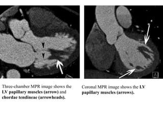 Three-chamber MPR image shows the
LV papillary muscles (arrow) and
chordae tendineae (arrowheads).
Coronal MPR image shows the LV
papillary muscles (arrows).
 