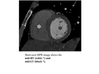 Short-axis MPR image shows the
mid-RV (white *) and
mid-LV (black *).
 