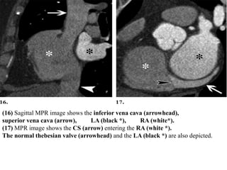 (16) Sagittal MPR image shows the inferior vena cava (arrowhead),
superior vena cava (arrow), LA (black *), RA (white*).
(17) MPR image shows the CS (arrow) entering the RA (white *).
The normal thebesian valve (arrowhead) and the LA (black *) are also depicted.
 
