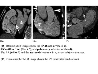 (18) Oblique MPR images show the RA (black arrow in a),
RV outflow tract (black *), and pulmonary valve (arrowhead).
The LA (white *) and the aorta (white arrow in a, arrow in b) are also seen.
(19) Three-chamber MPR image shows the RV moderator band (arrow).
 