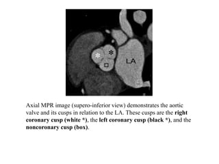 Axial MPR image (supero-inferior view) demonstrates the aortic
valve and its cusps in relation to the LA. These cusps are the right
coronary cusp (white *), the left coronary cusp (black *), and the
noncoronary cusp (box).
 