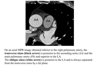 On an axial MPR image obtained inferior to the right pulmonary artery, the
transverse sinus (black arrow) is posterior to the ascending aorta (AA) and the
main pulmonary artery (PA) and superior to the LA.
The oblique sinus (white arrow) is posterior to the LA and is always separated
from the transverse sinus by a fat plane.
 