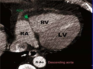 Cardiac ct ccta2 | PPTX