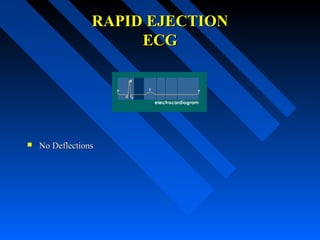 RAPID EJECTIONRAPID EJECTION
ECGECG
 No DeflectionsNo Deflections
 