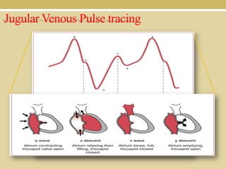 Jugular Venous Pulse tracing

 