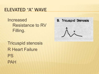 Increased
Resistance to RV
Filling.
Tricuspid stenosis
R Heart Failure
PS
PAH
ELEVATED “A” WAVE
 