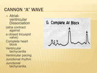  Atrial-
ventricular
Dissociation
(atria contract
against
a closed tricuspid
valve)
Complete heart
block
Ventricular
tachycardia
Ventricular pacing
Junctional rhythm
Junctional
tachycardia.
CANNON “A” WAVE
 