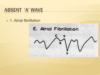 ABSENT ‘A’ WAVE
 1. Atrial fibrillation
 