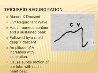  Absent X Decsent
 CV/ Regurgitant Wave
 Has a rounded contour
and a sustained peak
 Followed by a rapid
deep Y descent
 Amplitude of V
increases with
inspiration.
 Cause subtle motion of
ear lobe with each
heart beat
TRICUSPID REGURGITATION
 