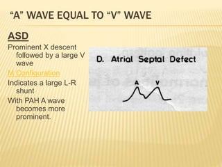 ASD
Prominent X descent
followed by a large V
wave
M Configuration
Indicates a large L-R
shunt
With PAH A wave
becomes more
prominent.
“A” WAVE EQUAL TO “V” WAVE
 