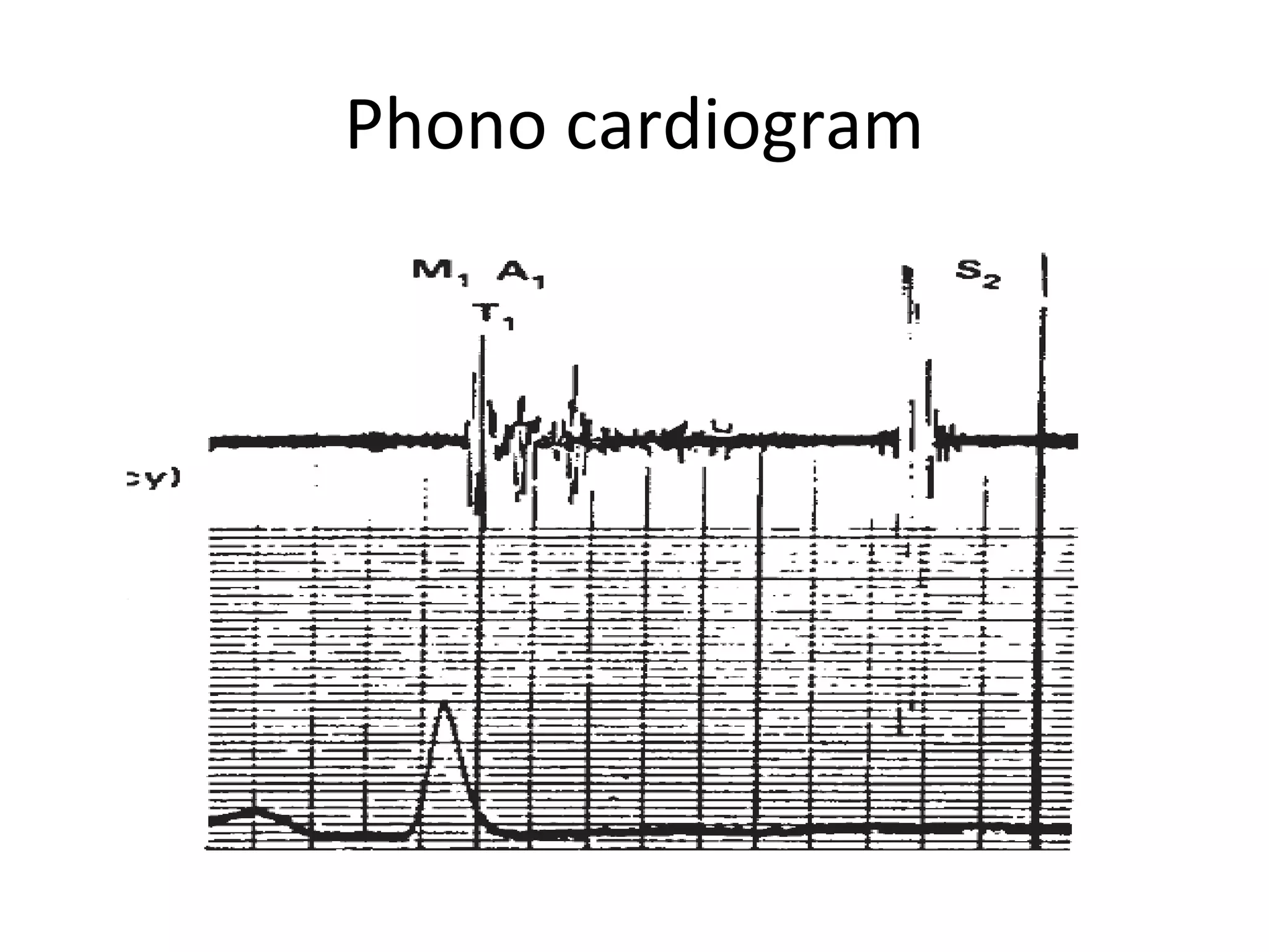 Phono cardiogram
 
