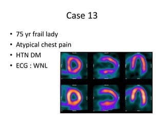Case 13
• 75 yr frail lady
• Atypical chest pain
• HTN DM
• ECG : WNL
 