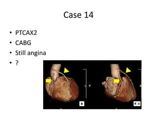 Case 14
• PTCAX2
• CABG
• Still angina
• ?
 