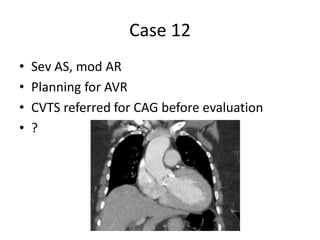 Case 12
• Sev AS, mod AR
• Planning for AVR
• CVTS referred for CAG before evaluation
• ?
 