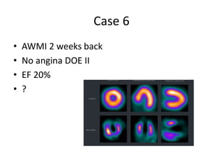 Case 6
• AWMI 2 weeks back
• No angina DOE II
• EF 20%
• ?
 