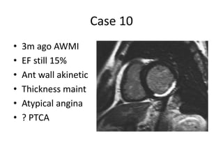 Case 10
• 3m ago AWMI
• EF still 15%
• Ant wall akinetic
• Thickness maint
• Atypical angina
• ? PTCA
 