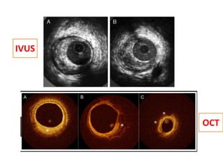 IVUS
OCT
 