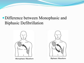 Difference between Monophasic and
Biphasic Defibrillation
 