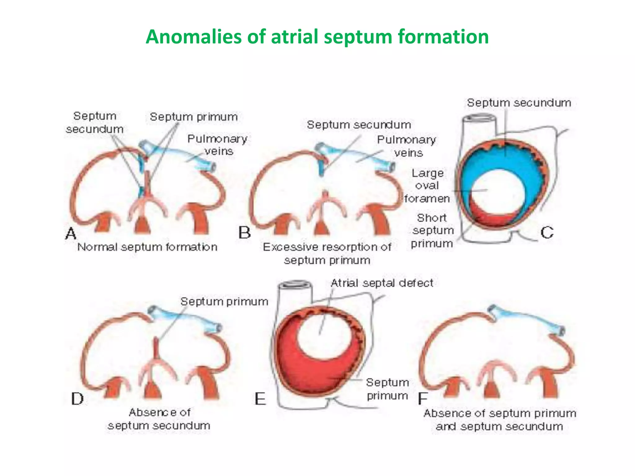 Anomalies of atrial septum formation
 