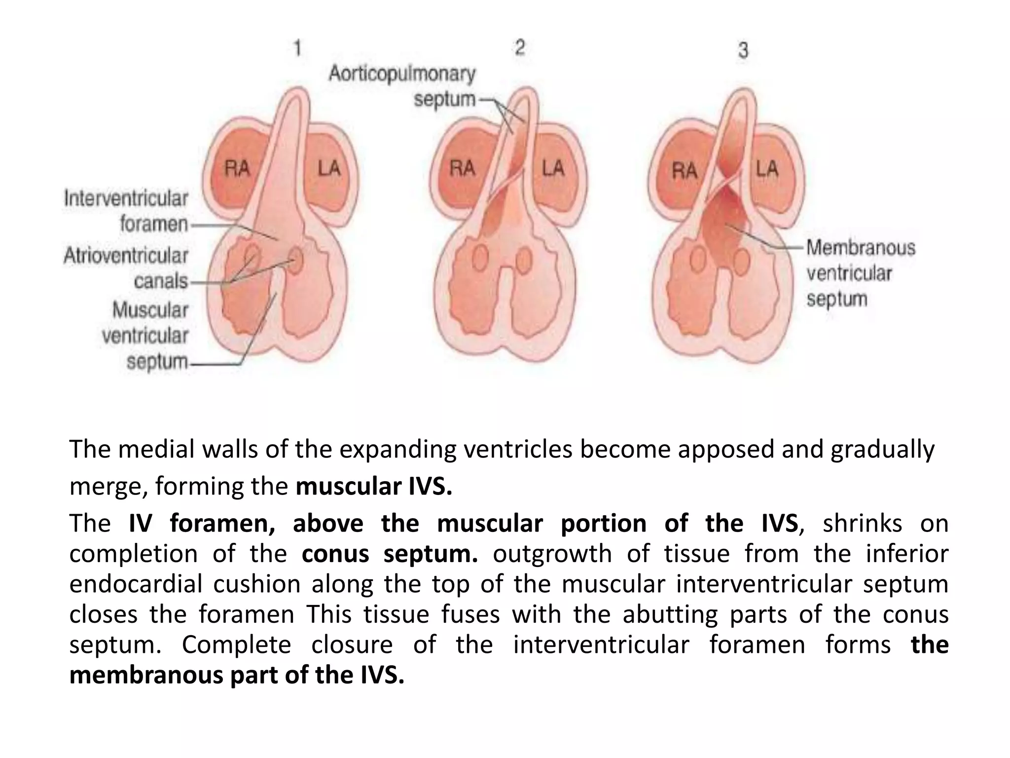 The medial walls of the expanding ventricles become apposed and gradually
merge, forming the muscular IVS.
The IV foramen, above the muscular portion of the IVS, shrinks on
completion of the conus septum. outgrowth of tissue from the inferior
endocardial cushion along the top of the muscular interventricular septum
closes the foramen This tissue fuses with the abutting parts of the conus
septum. Complete closure of the interventricular foramen forms the
membranous part of the IVS.
 