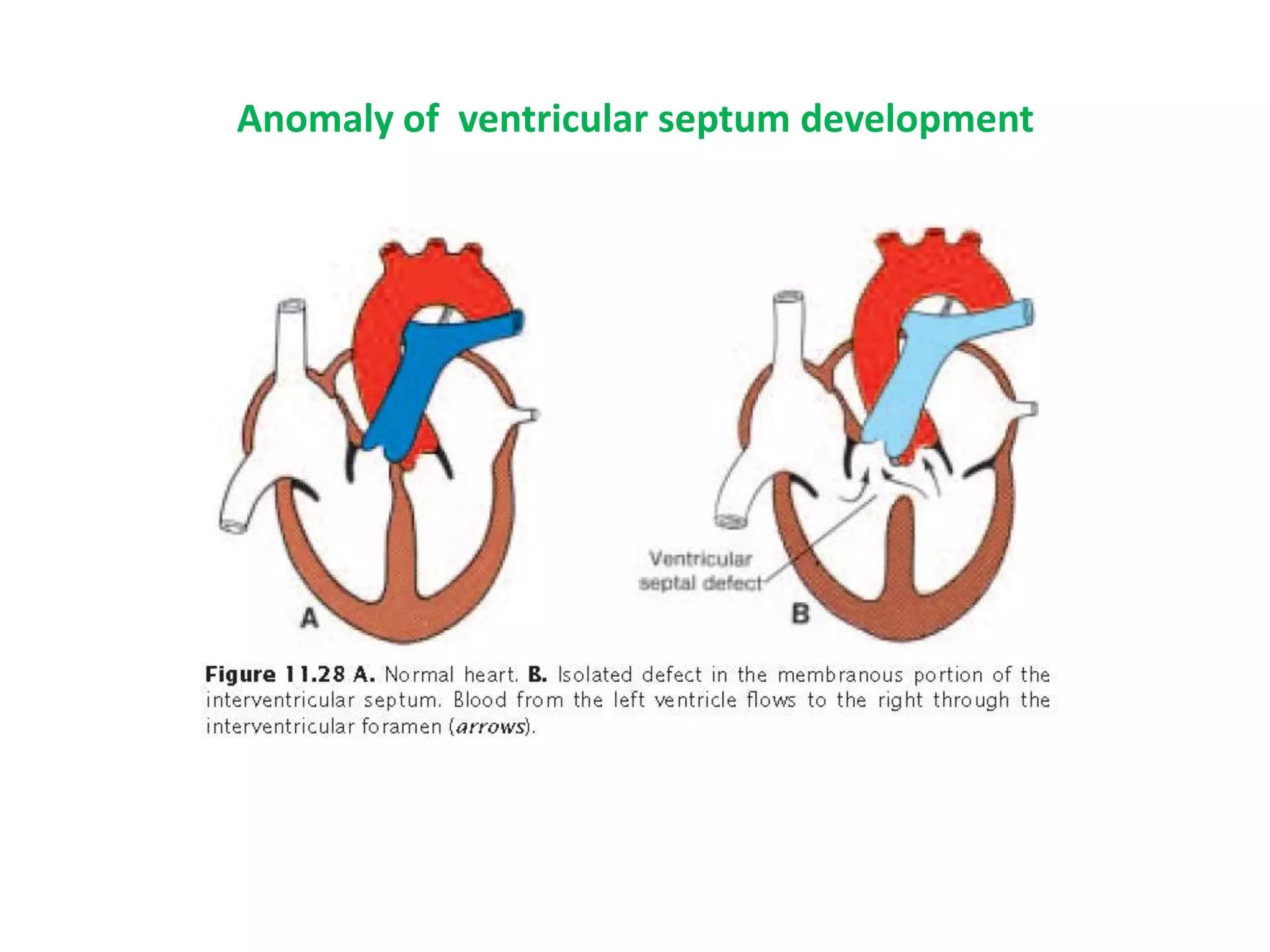 Anomaly of ventricular septum development
 