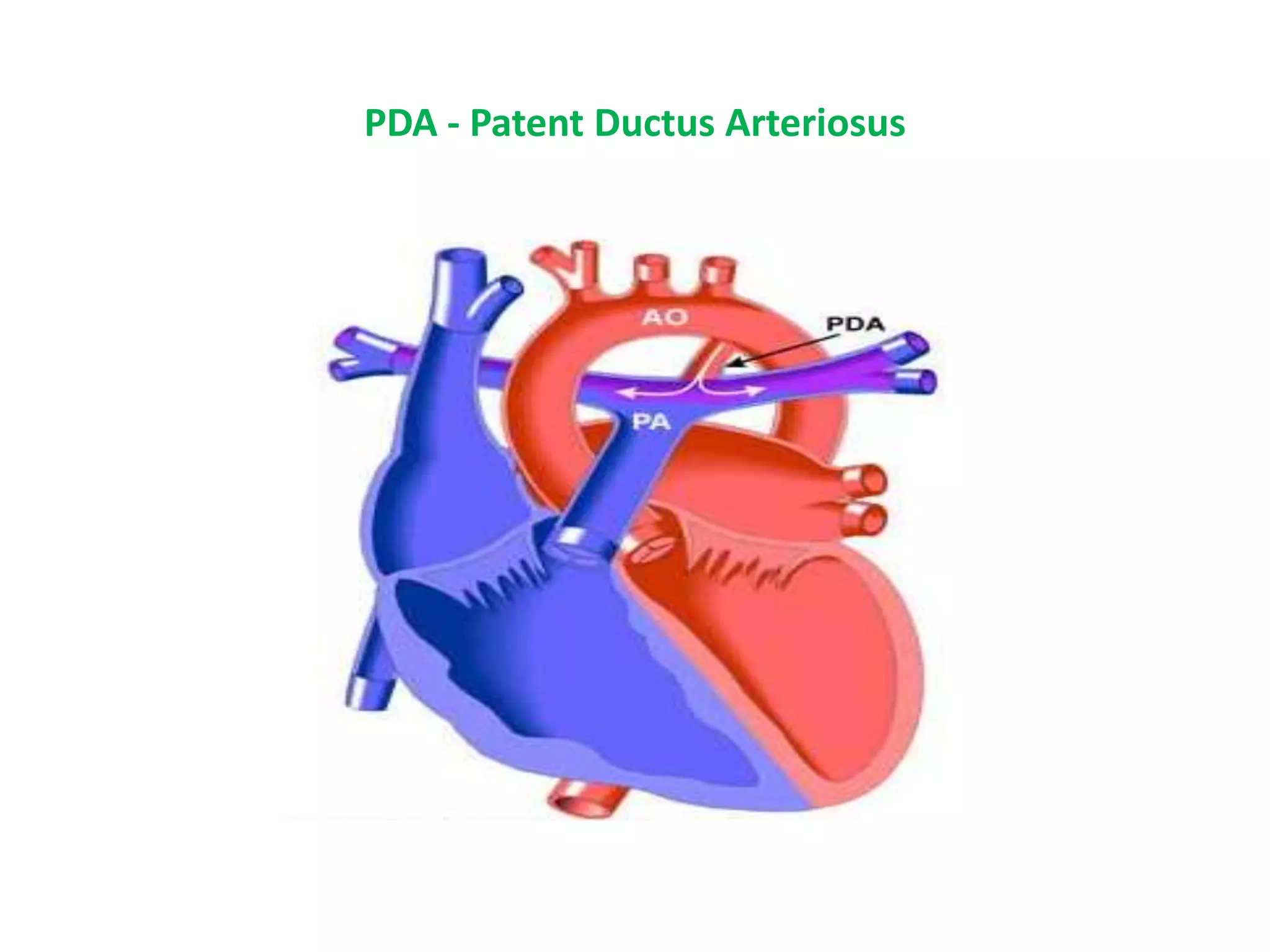 PDA - Patent Ductus Arteriosus
 