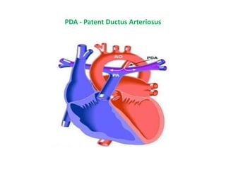 PDA - Patent Ductus Arteriosus
 